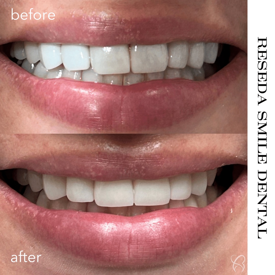 Before and After Image: Case 1 - front