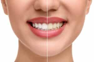 Collage of a woman’s smile before and after teeth whitening, highlighting brighter and whiter teeth against a white background.