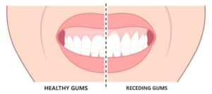 A detailed view of the gums and teeth highlights the preparation for a gingivectomy and gum graft, with laser treatment and deep cleaning to remove plaque, tartar, and calculus from the attached gingiva and alveolar bone.
